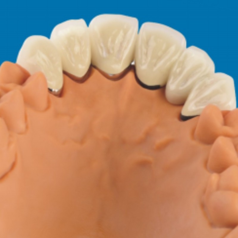 Metallo-denti in porcellana